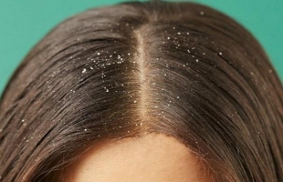 وصفات طبيعية لعلاج قشرة الشعر.. اعرفيها