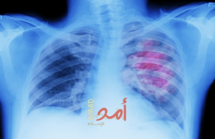 نصائح لمريض حساسية الصدر.. يجب اتباعها