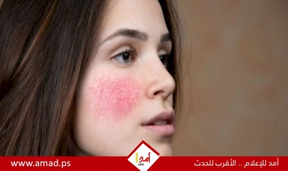 وصفات طبيعية لتهدئة احمرار البشرة بعد التعرض للشمس